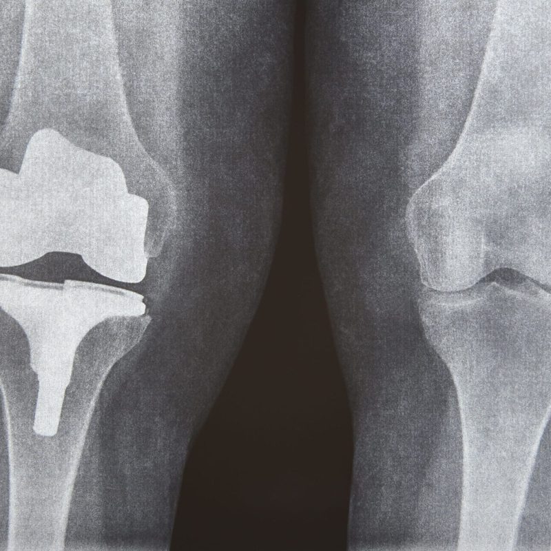 Radiografía de unas rodillas, una de ellas con protesis